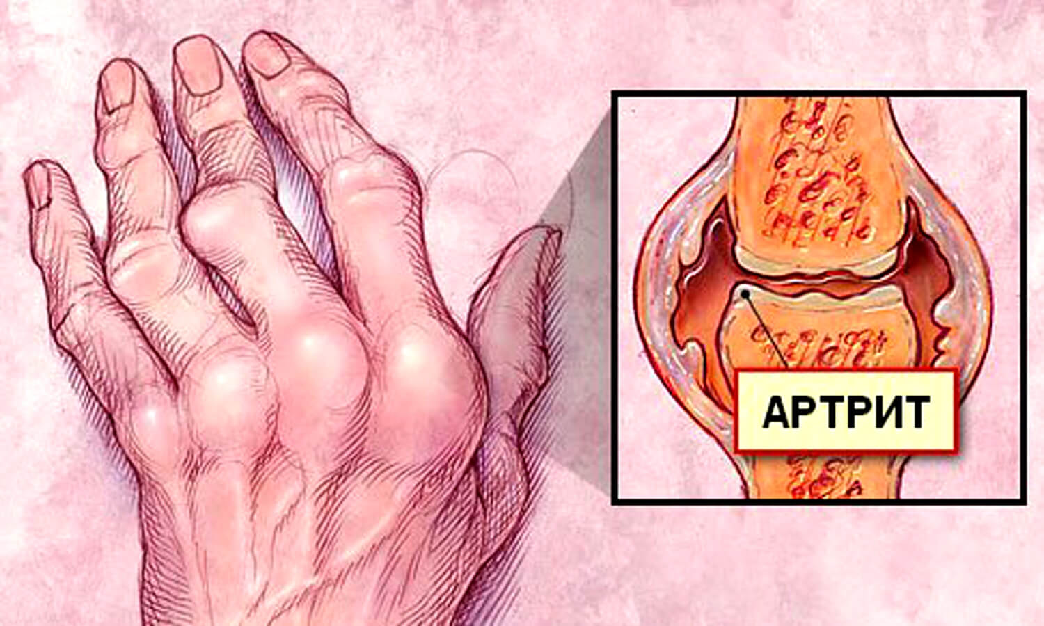 Como aliviar brote de artritis