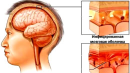 Признаки раннего нейроборрелиоза